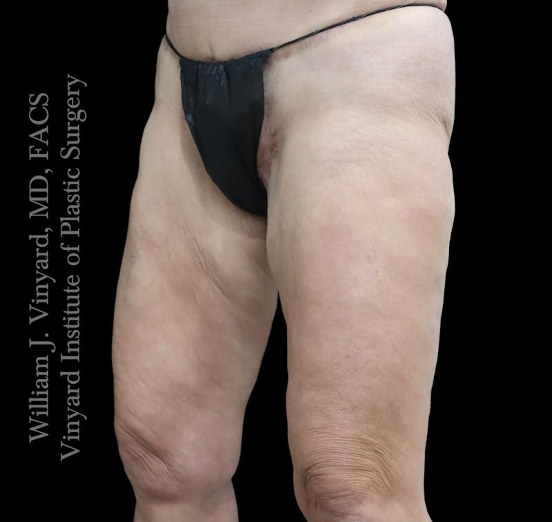 Thigh Lift/Lower Body Lift Before & After Gallery - Patient 351094 - Image 3