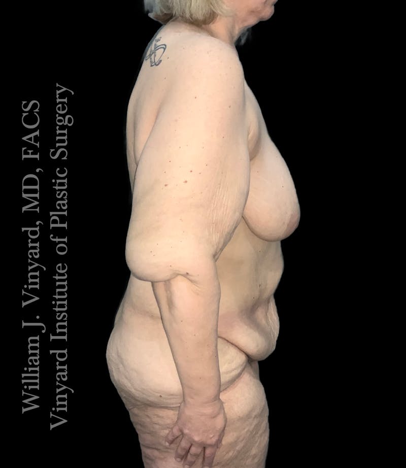Post Weight Loss Makeovers Before & After Gallery - Patient 219299 - Image 3