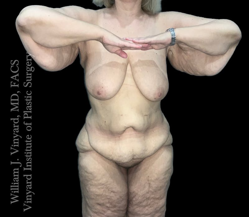 Post Weight Loss Makeovers Before & After Gallery - Patient 219299 - Image 1