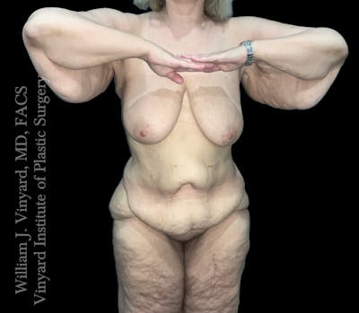 Post Weight Loss Makeovers Before & After Gallery - Patient 219299 - Image 1