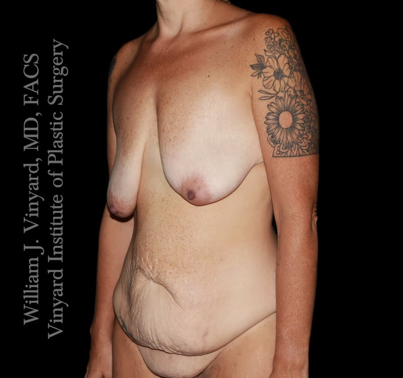 Post Weight Loss Makeovers Before & After Gallery - Patient 597029 - Image 7