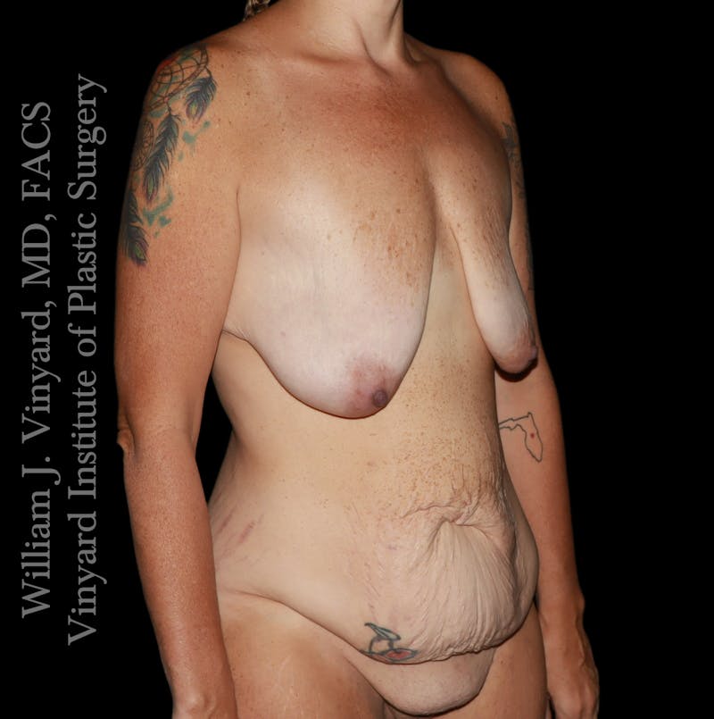 Post Weight Loss Makeovers Before & After Gallery - Patient 597029 - Image 3