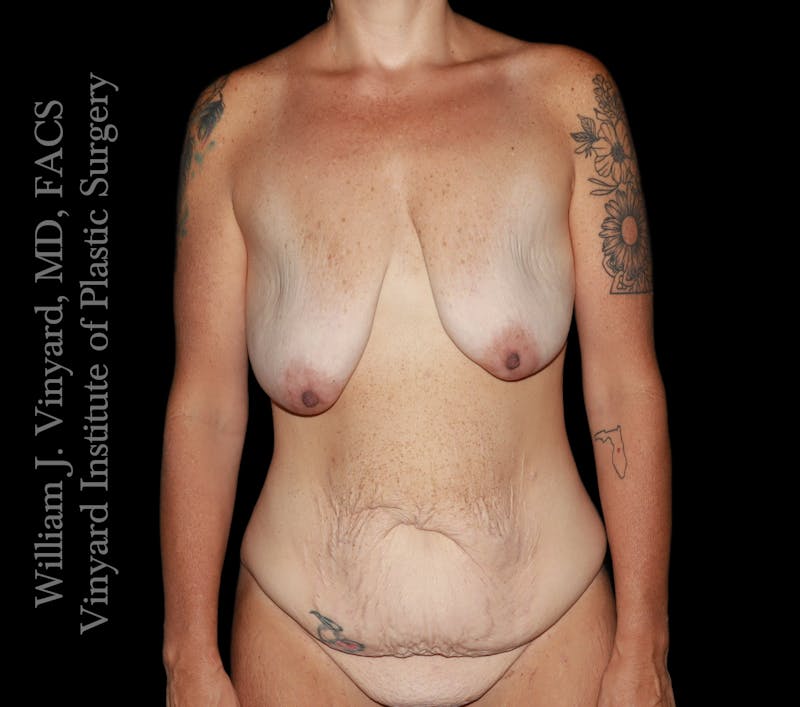 Post Weight Loss Makeovers Before & After Gallery - Patient 597029 - Image 1