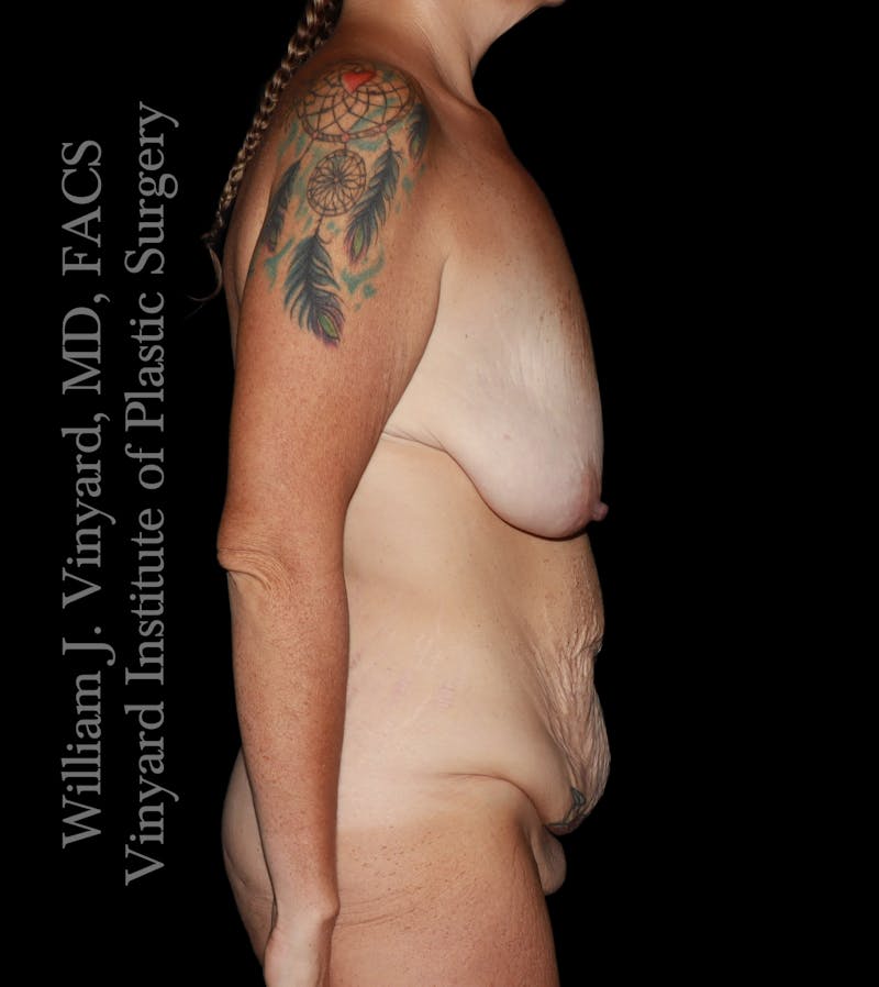 Post Weight Loss Makeovers Before & After Gallery - Patient 597029 - Image 5