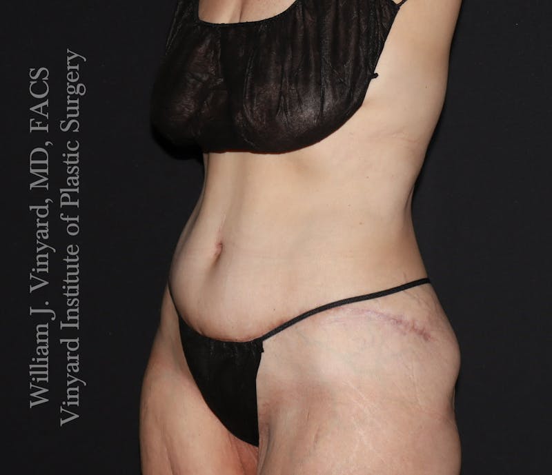 Post Weight Loss Makeovers Before & After Gallery - Patient 712338 - Image 4