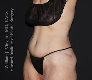 Post Weight Loss Makeovers Before & After Gallery - Patient 712338 - Image 4