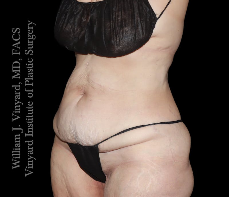 Post Weight Loss Makeovers Before & After Gallery - Patient 712338 - Image 3