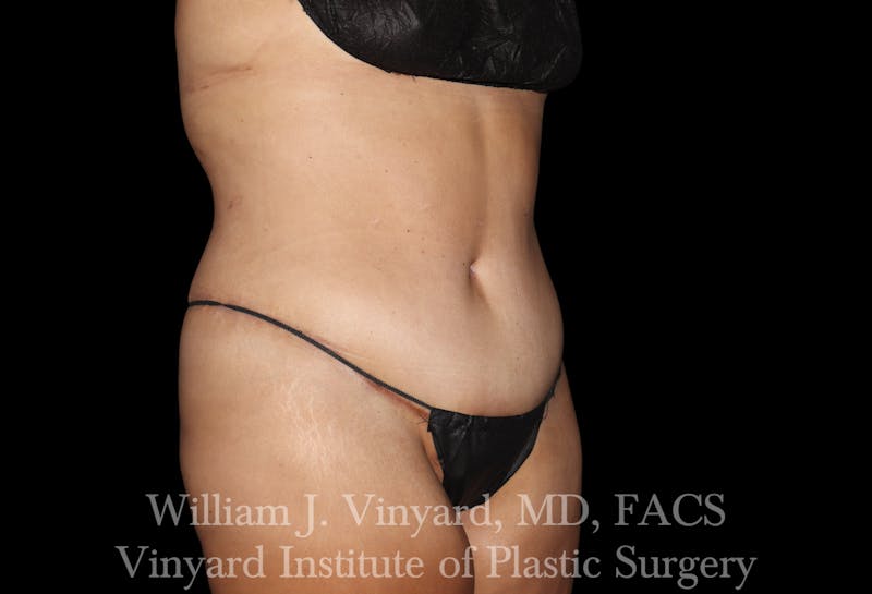 Post Weight Loss Makeovers Before & After Gallery - Patient 328158 - Image 6