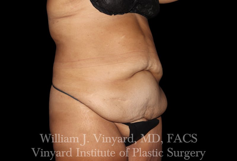 Post Weight Loss Makeovers Before & After Gallery - Patient 328158 - Image 5