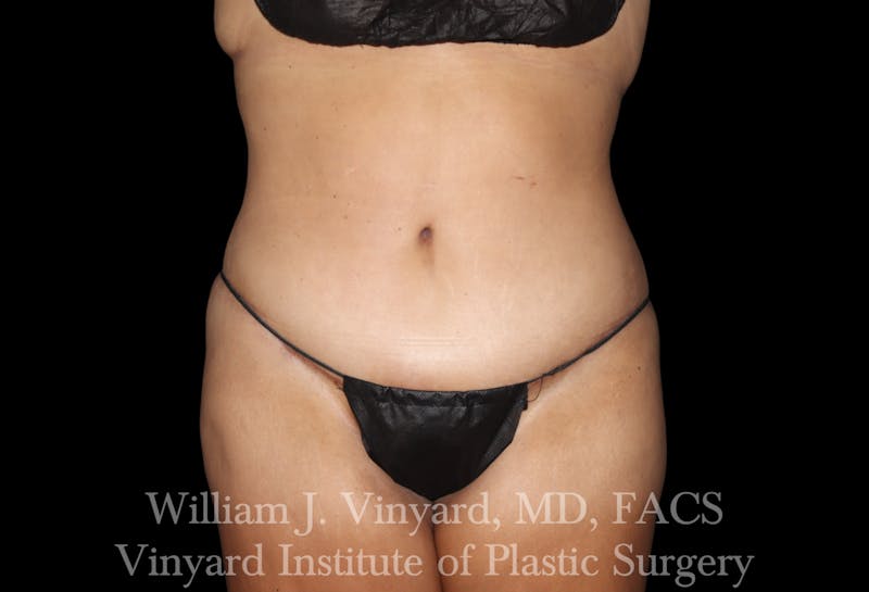 Post Weight Loss Makeovers Before & After Gallery - Patient 328158 - Image 2