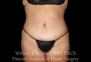 Post Weight Loss Makeovers Before & After Gallery - Patient 328158 - Image 2