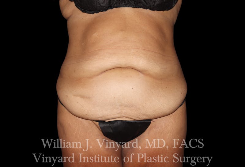 Post Weight Loss Makeovers Before & After Gallery - Patient 328158 - Image 1