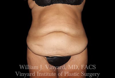 Post Weight Loss Makeovers Before & After Gallery - Patient 328158 - Image 1