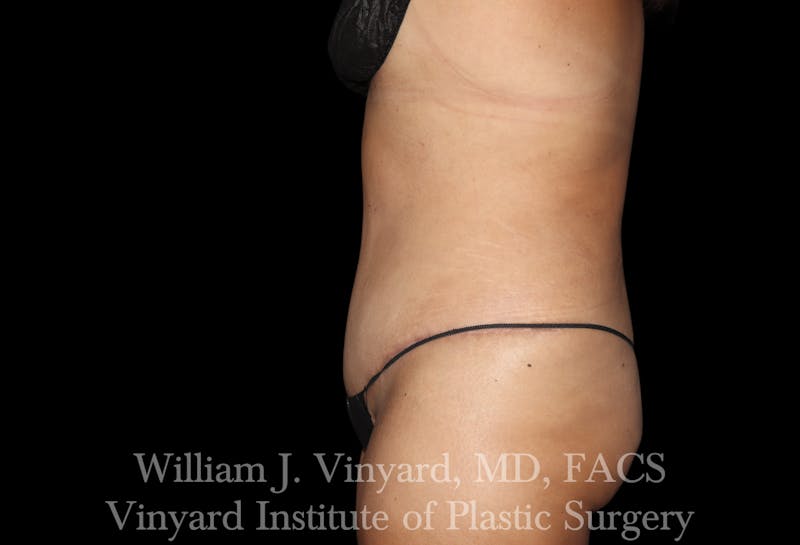Post Weight Loss Makeovers Before & After Gallery - Patient 328158 - Image 4