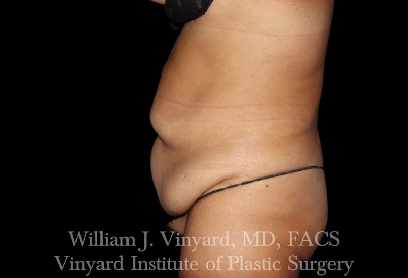Post Weight Loss Makeovers Before & After Gallery - Patient 328158 - Image 3
