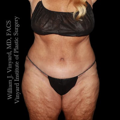 Post Weight Loss Makeovers Before & After Gallery - Patient 238988 - Image 2