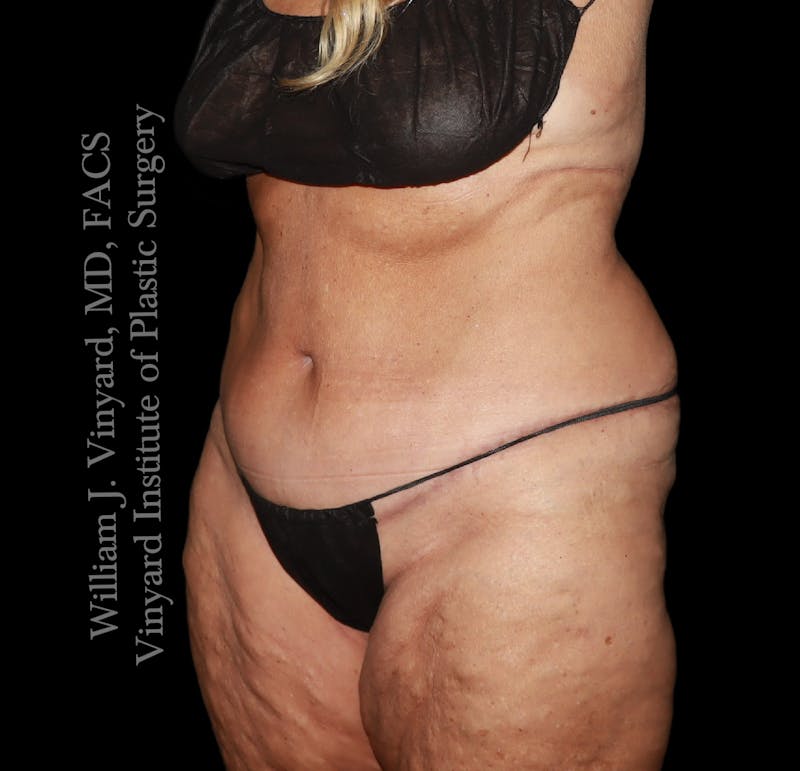 Post Weight Loss Makeovers Before & After Gallery - Patient 238988 - Image 4