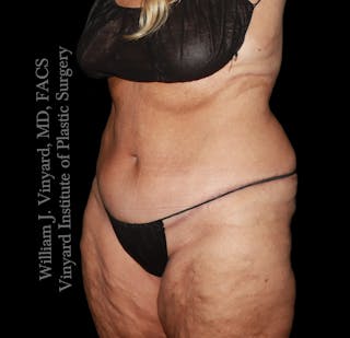 Post Weight Loss Makeovers Before & After Gallery - Patient 238988 - Image 4