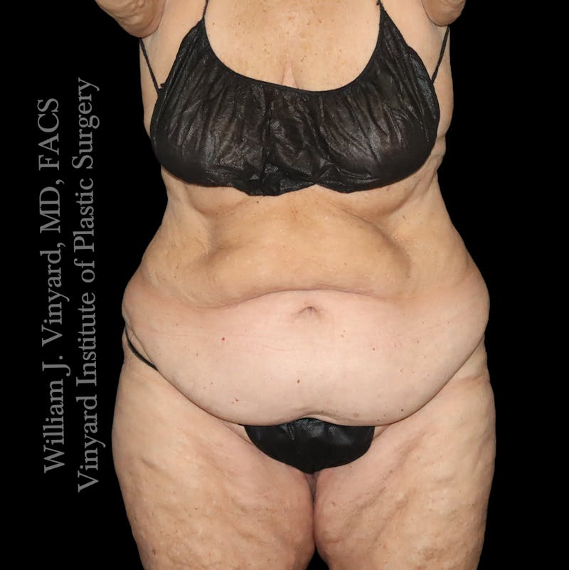 Post Weight Loss Makeovers Before & After Gallery - Patient 238988 - Image 1