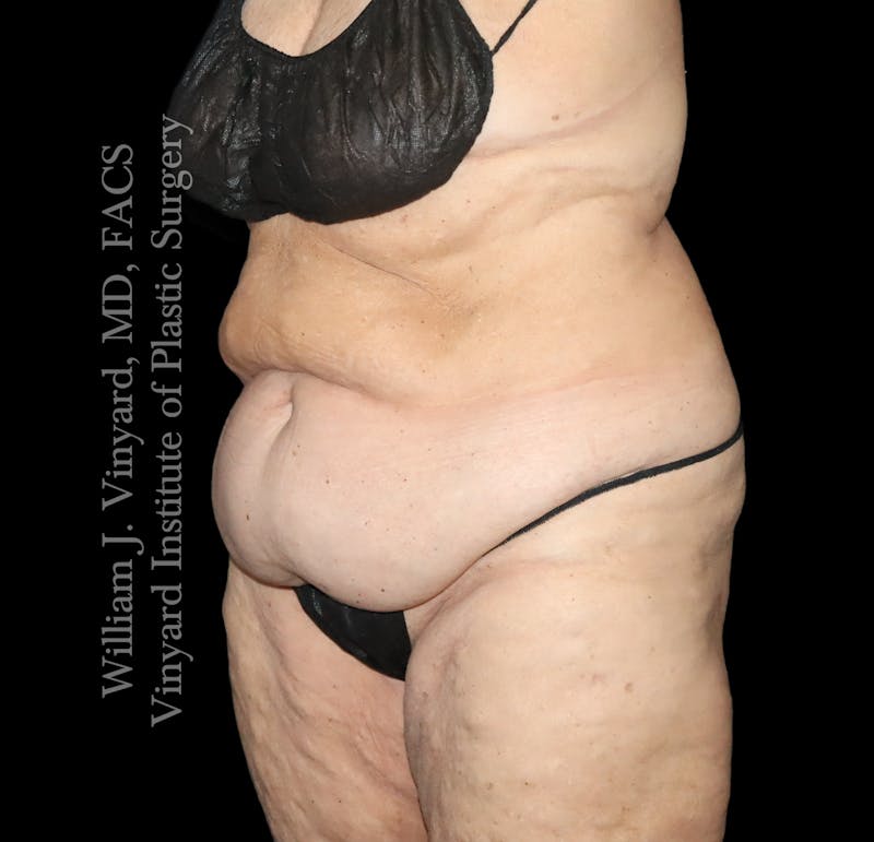 Post Weight Loss Makeovers Before & After Gallery - Patient 238988 - Image 3
