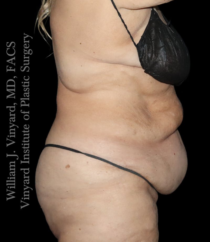 Post Weight Loss Makeovers Before & After Gallery - Patient 238988 - Image 5