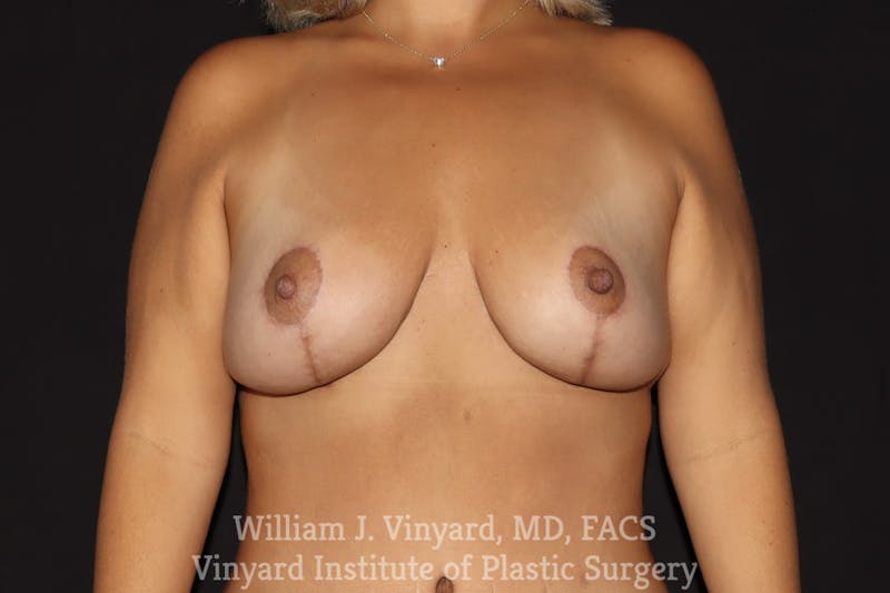 Breast Lift Before & After Gallery - Patient 409138 - Image 2