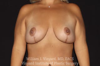 Breast Lift Before & After Gallery - Patient 409138 - Image 2