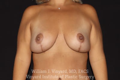 Breast Lift Before & After Gallery - Patient 409138 - Image 2