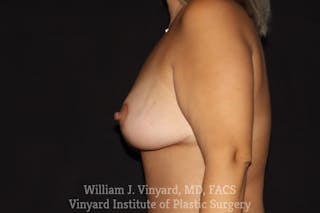 Breast Lift Before & After Gallery - Patient 409138 - Image 10
