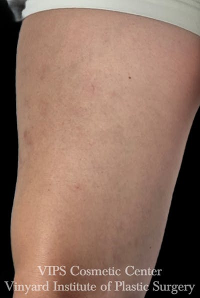 Laser Vein Removal Before & After Gallery - Patient 266938 - Image 1