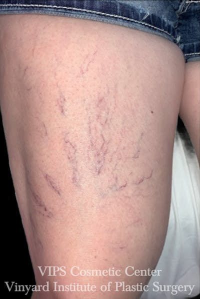 Laser Vein Removal Before & After Gallery - Patient 266938 - Image 2