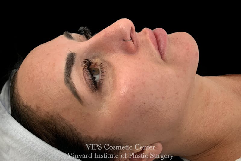 Diamondglow Before & After Gallery - Patient 327397 - Image 1