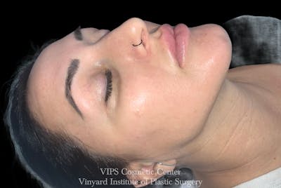 Diamondglow Before & After Gallery - Patient 327397 - Image 2