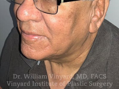 Diamondglow Before & After Gallery - Patient 380854 - Image 2
