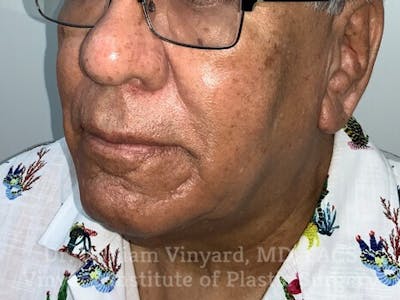 Diamondglow Before & After Gallery - Patient 380854 - Image 1