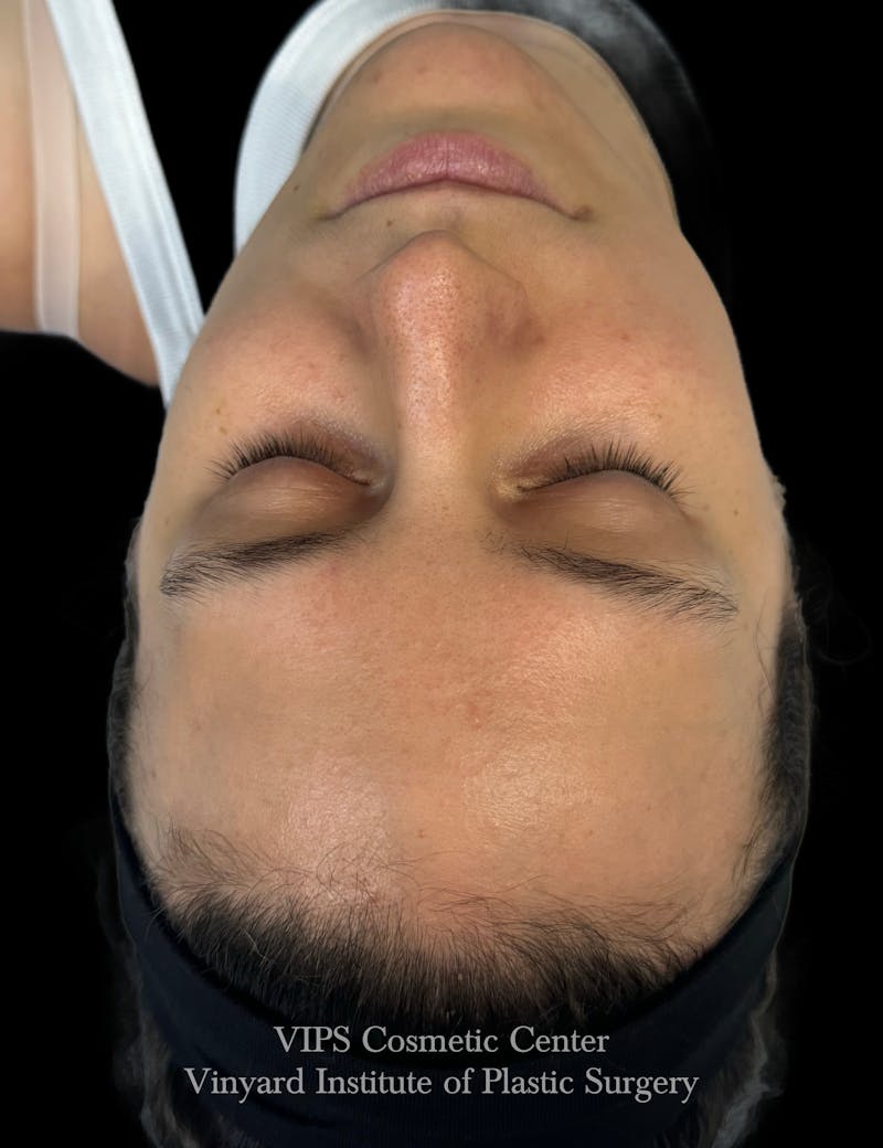 Diamondglow Before & After Gallery - Patient 236903 - Image 1