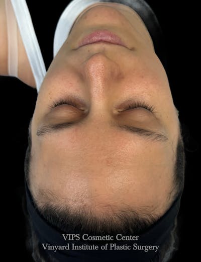 Diamondglow Before & After Gallery - Patient 236903 - Image 1