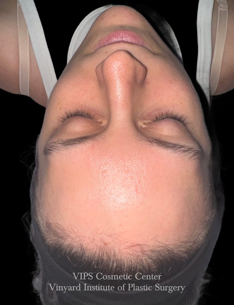 Diamondglow Before & After Gallery - Patient 236903 - Image 2