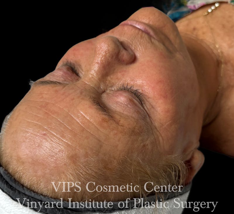 Diamondglow Before & After Gallery - Patient 404946 - Image 1
