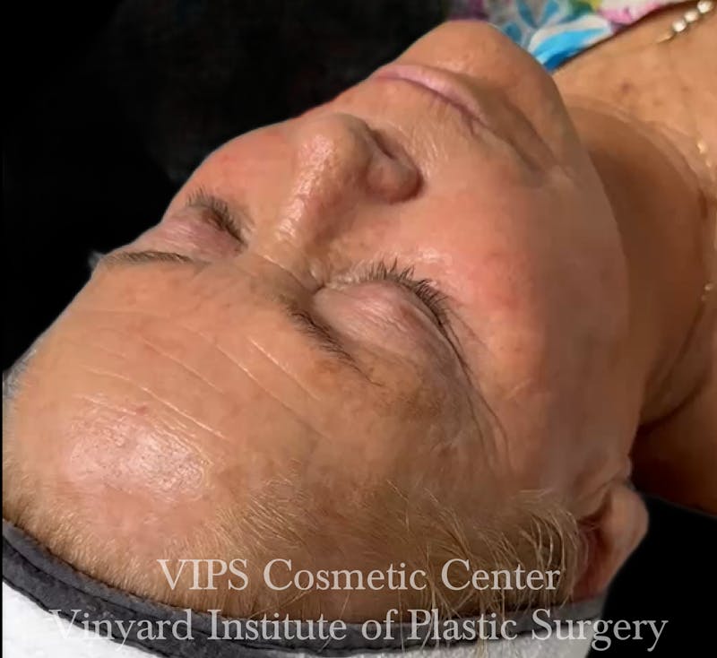 Diamondglow Before & After Gallery - Patient 404946 - Image 2