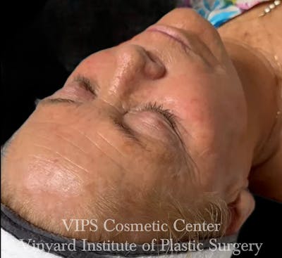 Diamondglow Before & After Gallery - Patient 404946 - Image 2