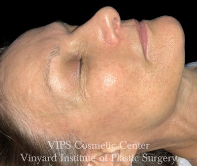 Diamondglow Before & After Gallery - Patient 253599 - Image 1