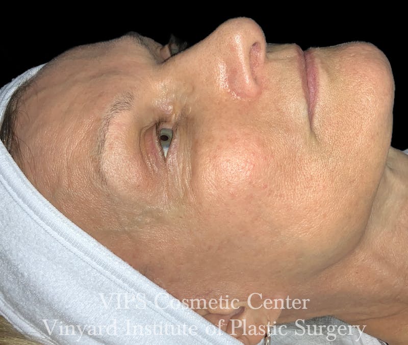 Diamondglow Before & After Gallery - Patient 253599 - Image 2