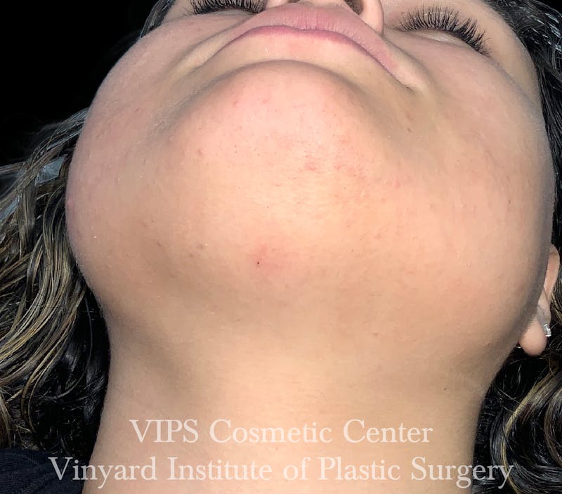 Laser Hair Removal Before & After Gallery - Patient 267163 - Image 2