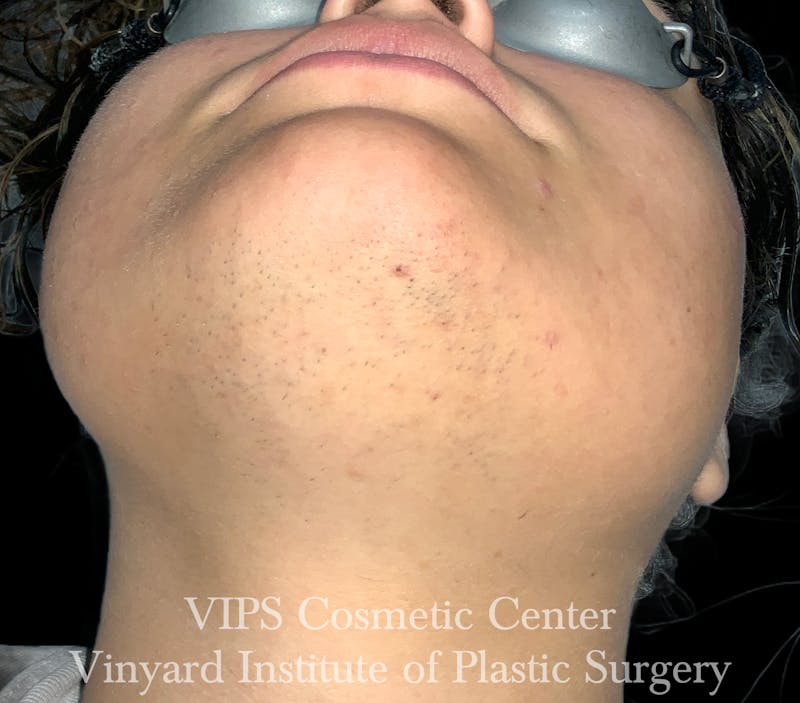 Laser Hair Removal Before & After Gallery - Patient 267163 - Image 1
