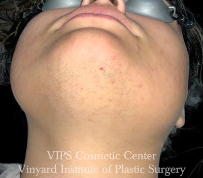Laser Hair Removal Before & After Gallery - Patient 267163 - Image 1