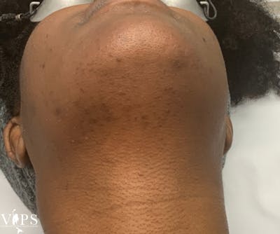 Laser Hair Removal Before & After Gallery - Patient 206264 - Image 2