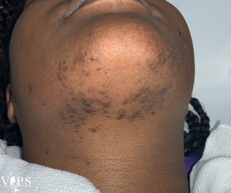 Laser Hair Removal Before & After Gallery - Patient 206264 - Image 1