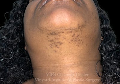 Laser Hair Removal Before & After Gallery - Patient 169943647 - Image 1