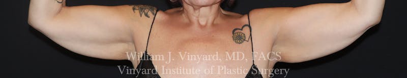 Post Weight Loss Makeovers Before & After Gallery - Patient 712338 - Image 11